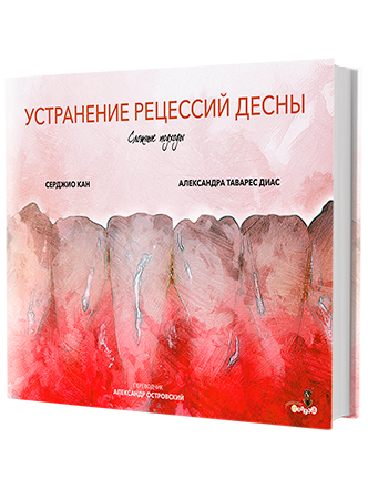 Устранение рецессий десны