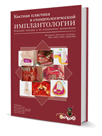 Костная пластика в стоматологической имплантологии. Описание методик и их клинического применения